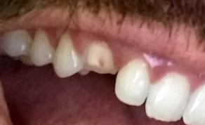 Broken Tooth